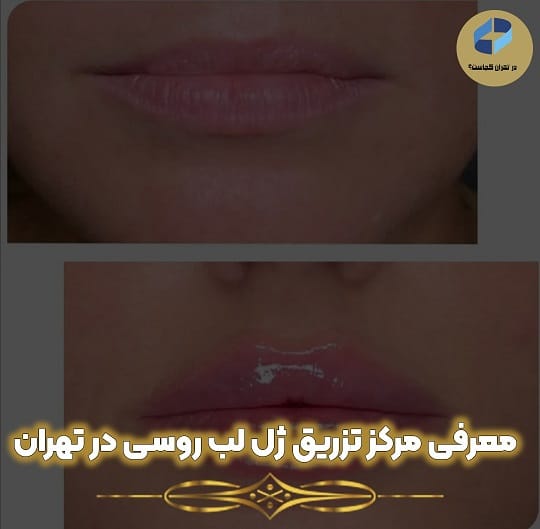 مرکز تزریق ژل لب روسی تهران