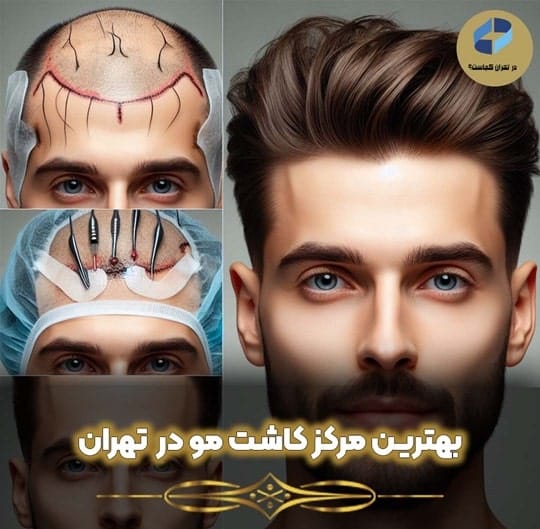 بهترین مرکز کاشت مو در تهران