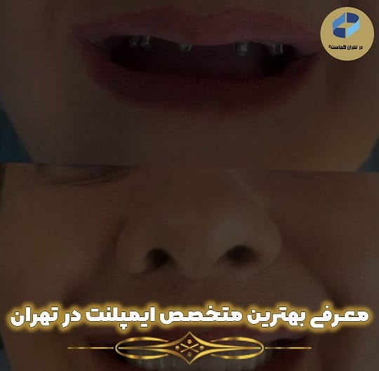 لیست 18 تایی بهترین متخصص ایمپلنت در تهران + تلفن تماس