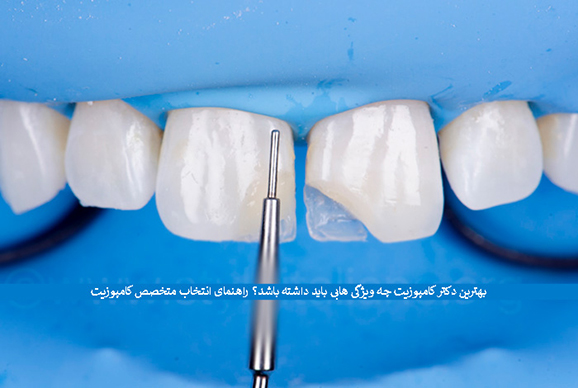نحوه انتخاب بهترین دکتر کامپوزیت