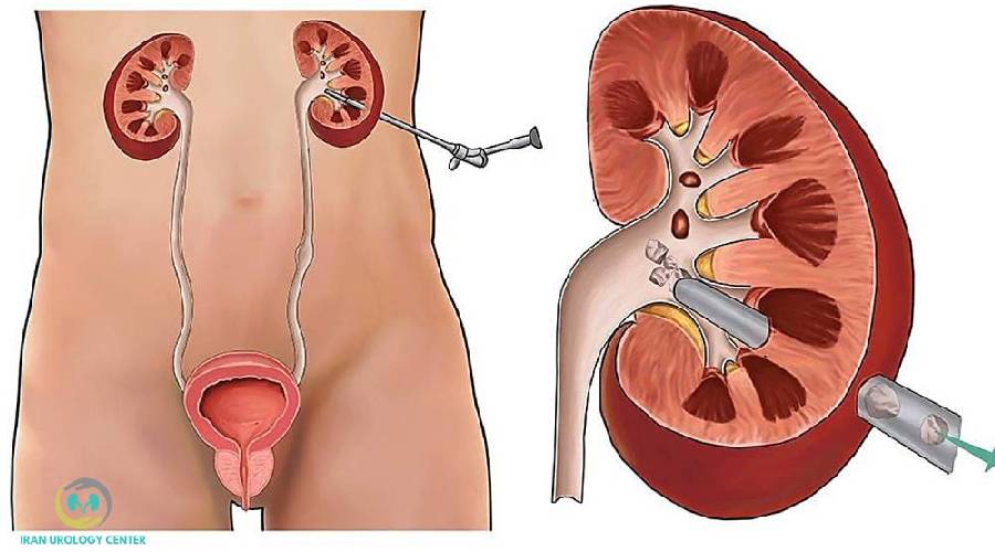 نقش آب زیاد و مایعات در دفع سنگ کلیه